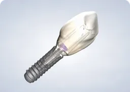 Home Dental Implants