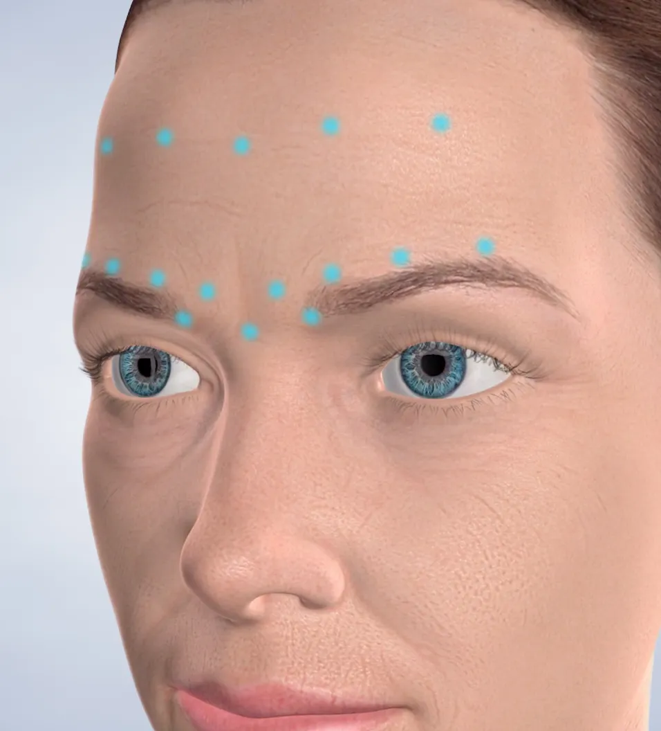 Query  botox